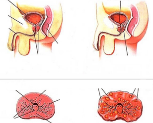 normální prostata a chronická prostatitida