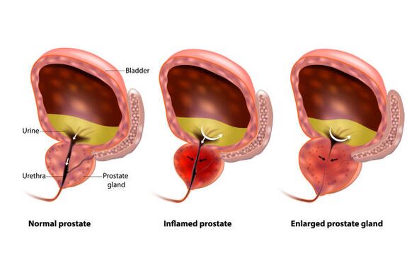 prostatitida je zánět prostaty