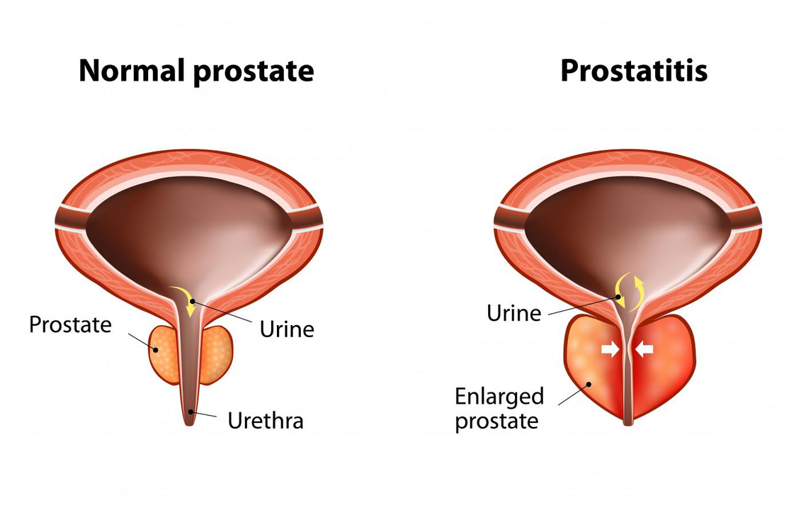 Normální prostata zdravého muže a zánět prostaty s prostatitidou