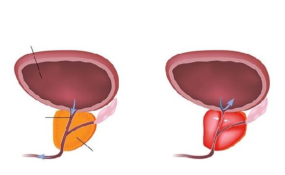 normální a zanícená prostata